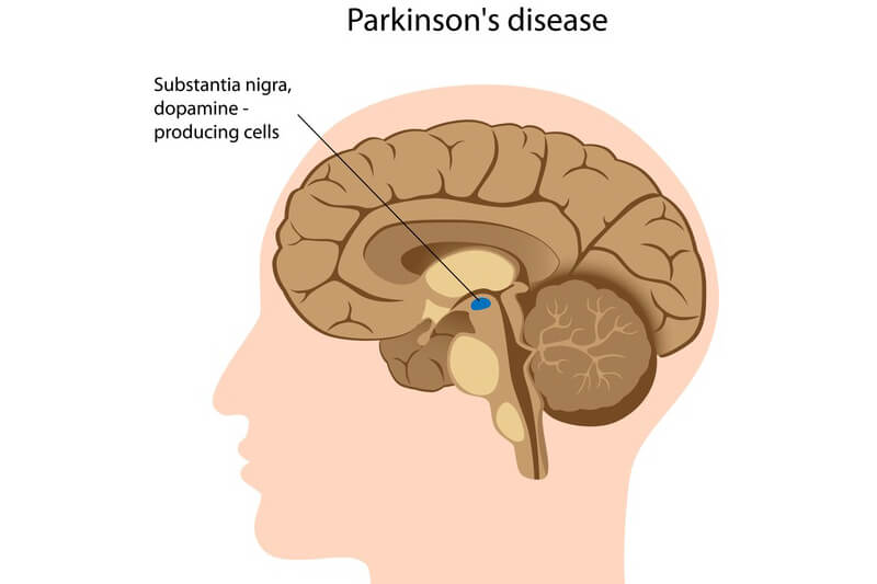 Parkinson’s-Disease (1)