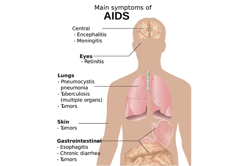 Symptoms_of_AIDS.svg (1)