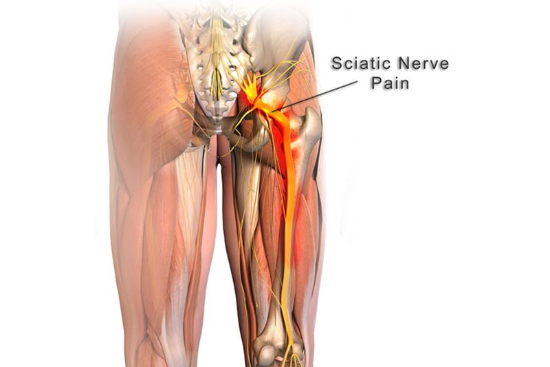 sciatic-nerve-and-nerve-pain