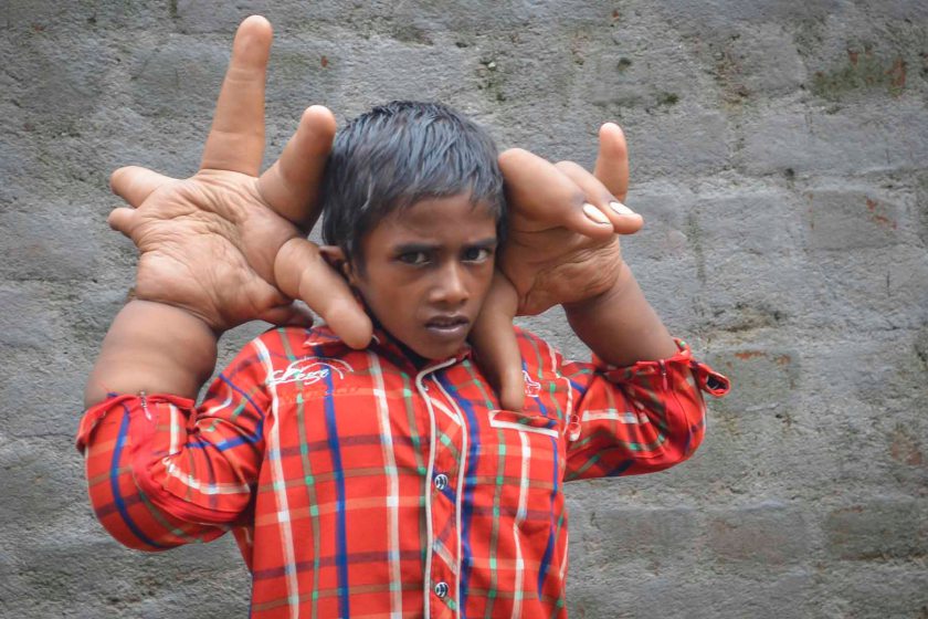 an-indian-boys-hands-grow-abnormally