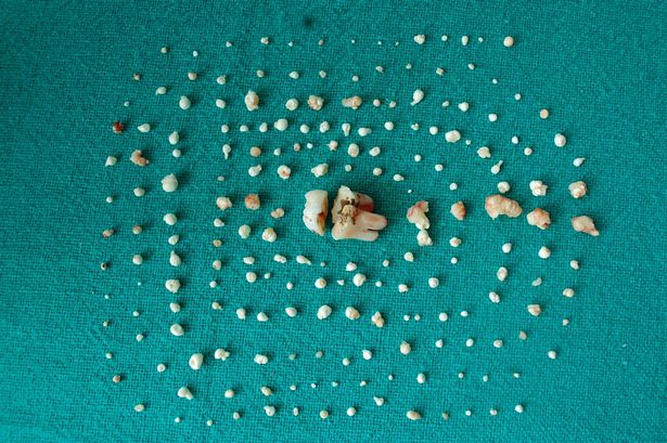 seven-year-old-girls-mouth-contains-more-than-200-teeth