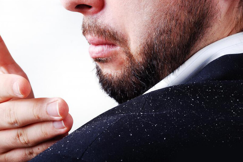 get-rid-dandruff-permanently-10-easy-remedies