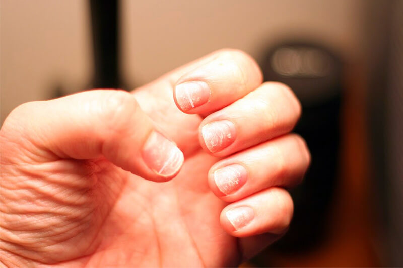 heres-why-you-see-white-spots-on-your-nails