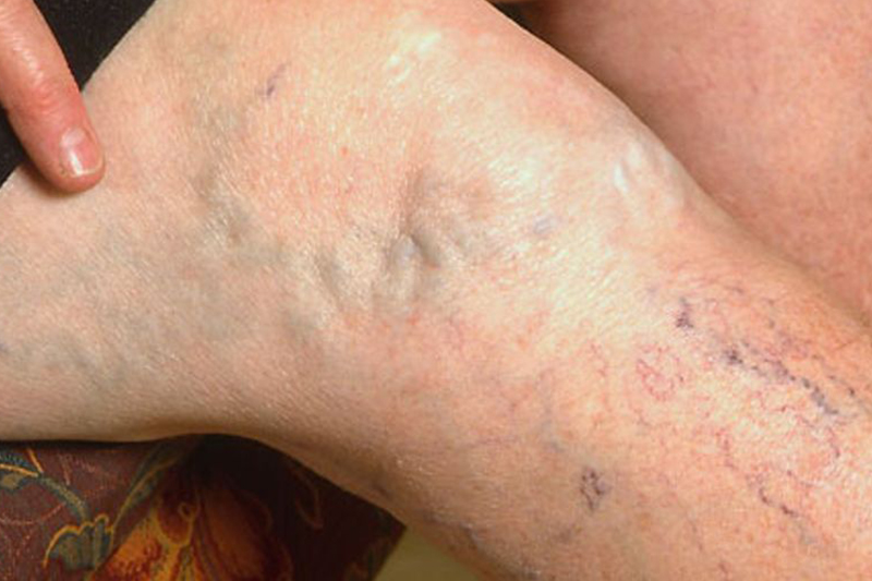 how-to-get-rid-of-spider-veins-with-vinegar