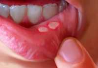 home-remedy-for-mouth-ulcers