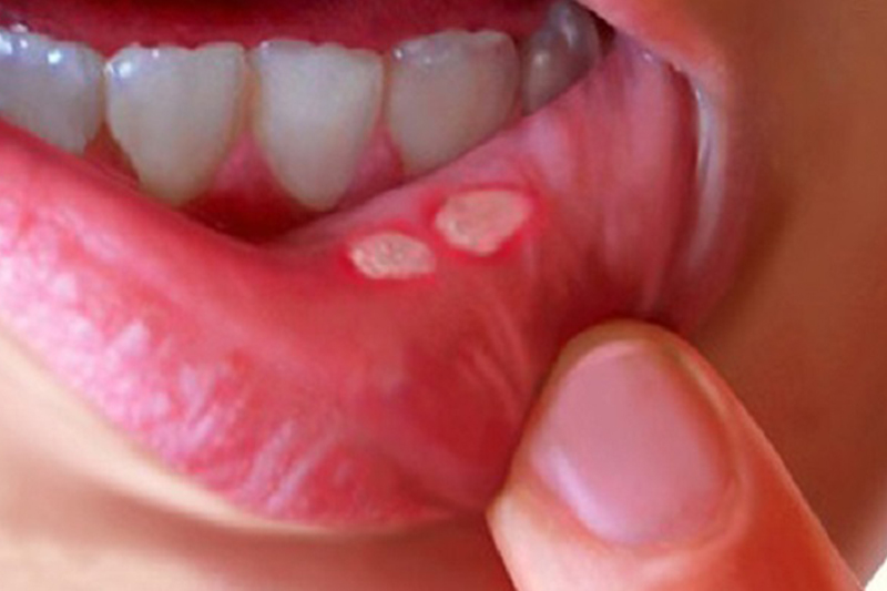 home-remedy-for-mouth-ulcers