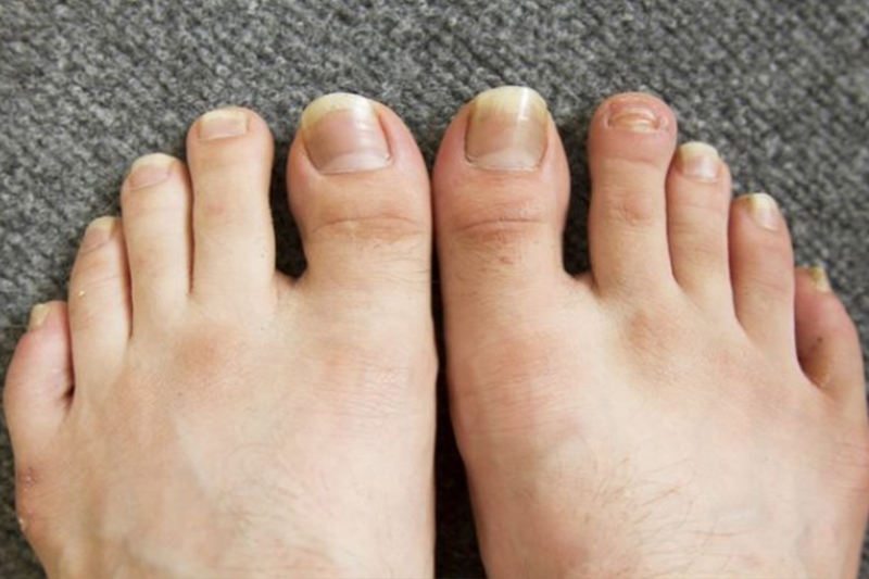 how-to-get-rid-of-toenail-fungus-fast