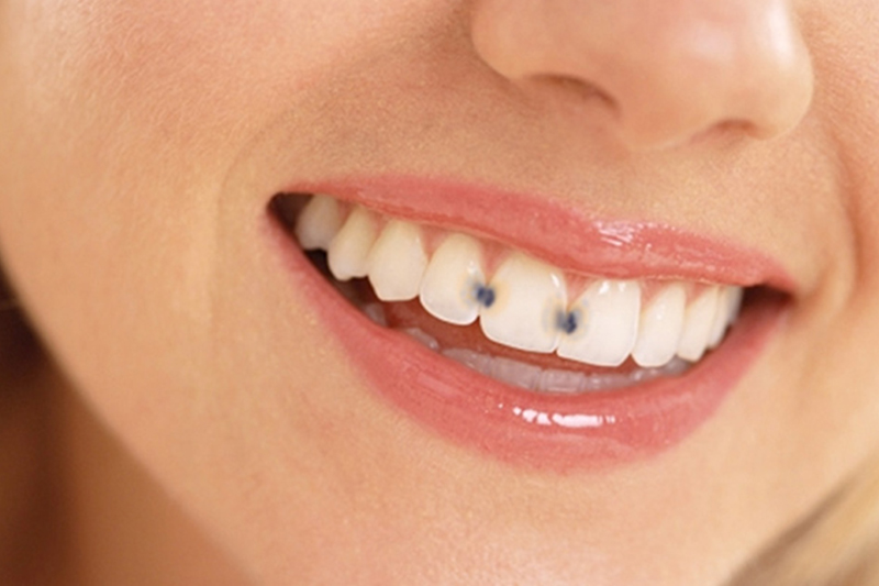 reverse-cavities-the-natural-way